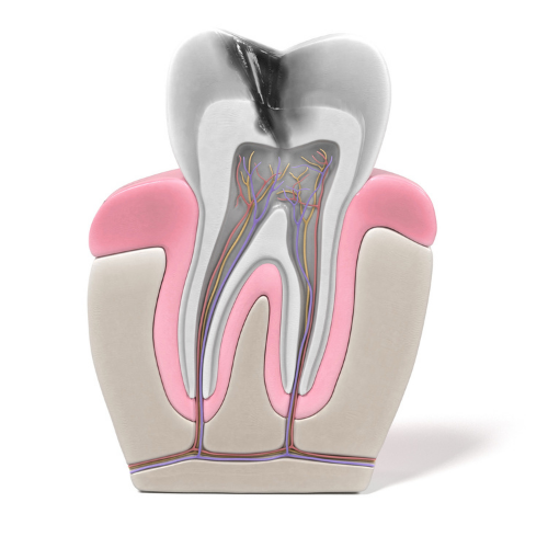 image showing root canal treatment | Friendswood TX Dentist for adults and children