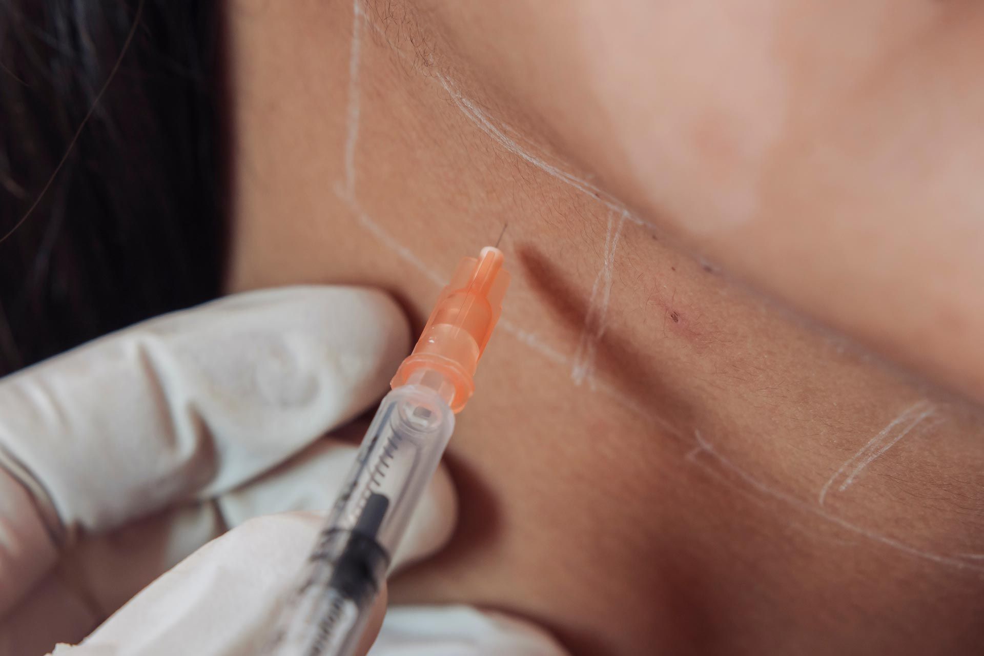Close-up of a hand injecting medication into a person’s neck with a syringe