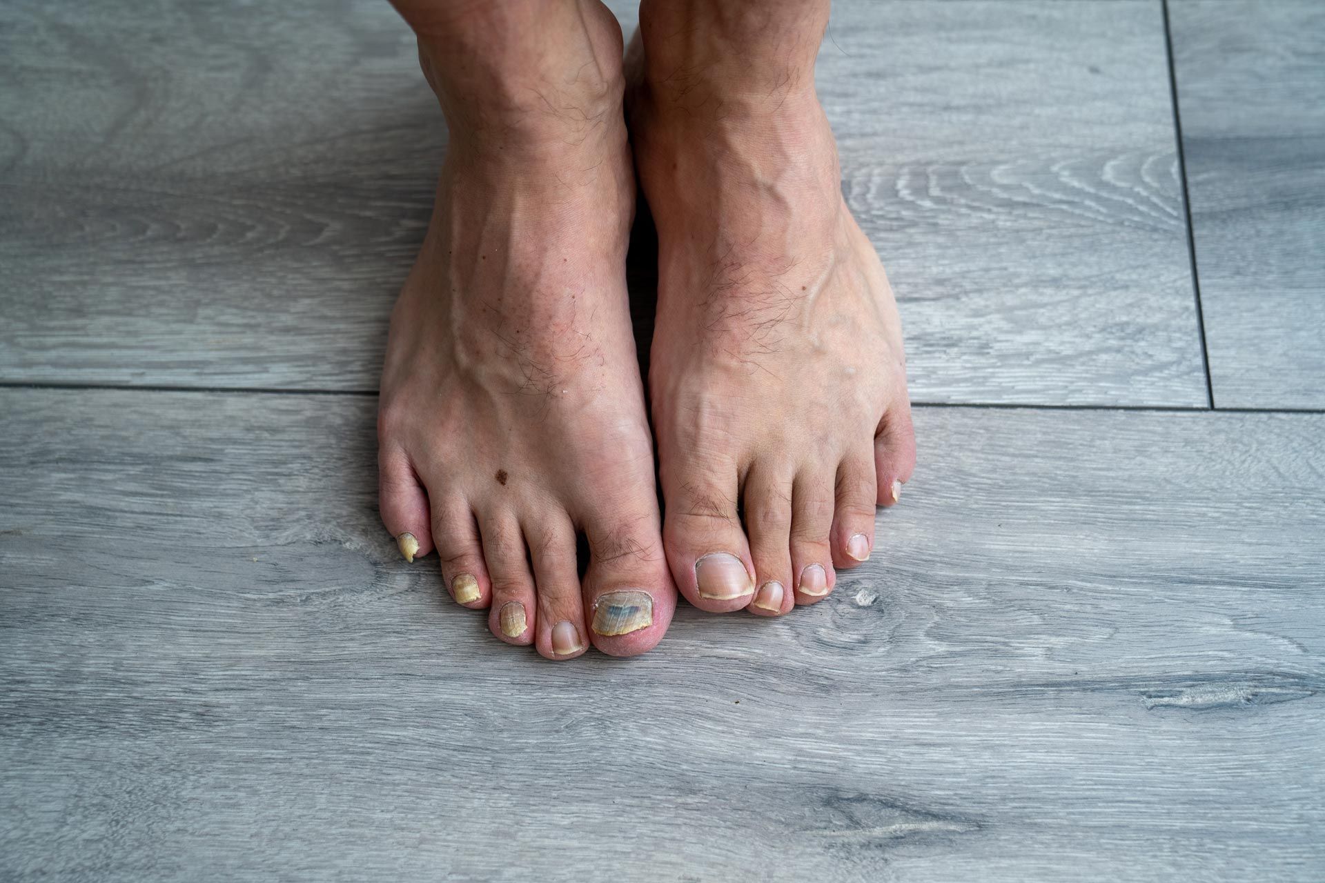 Bare feet with discolored toenails standing on a gray wooden floor