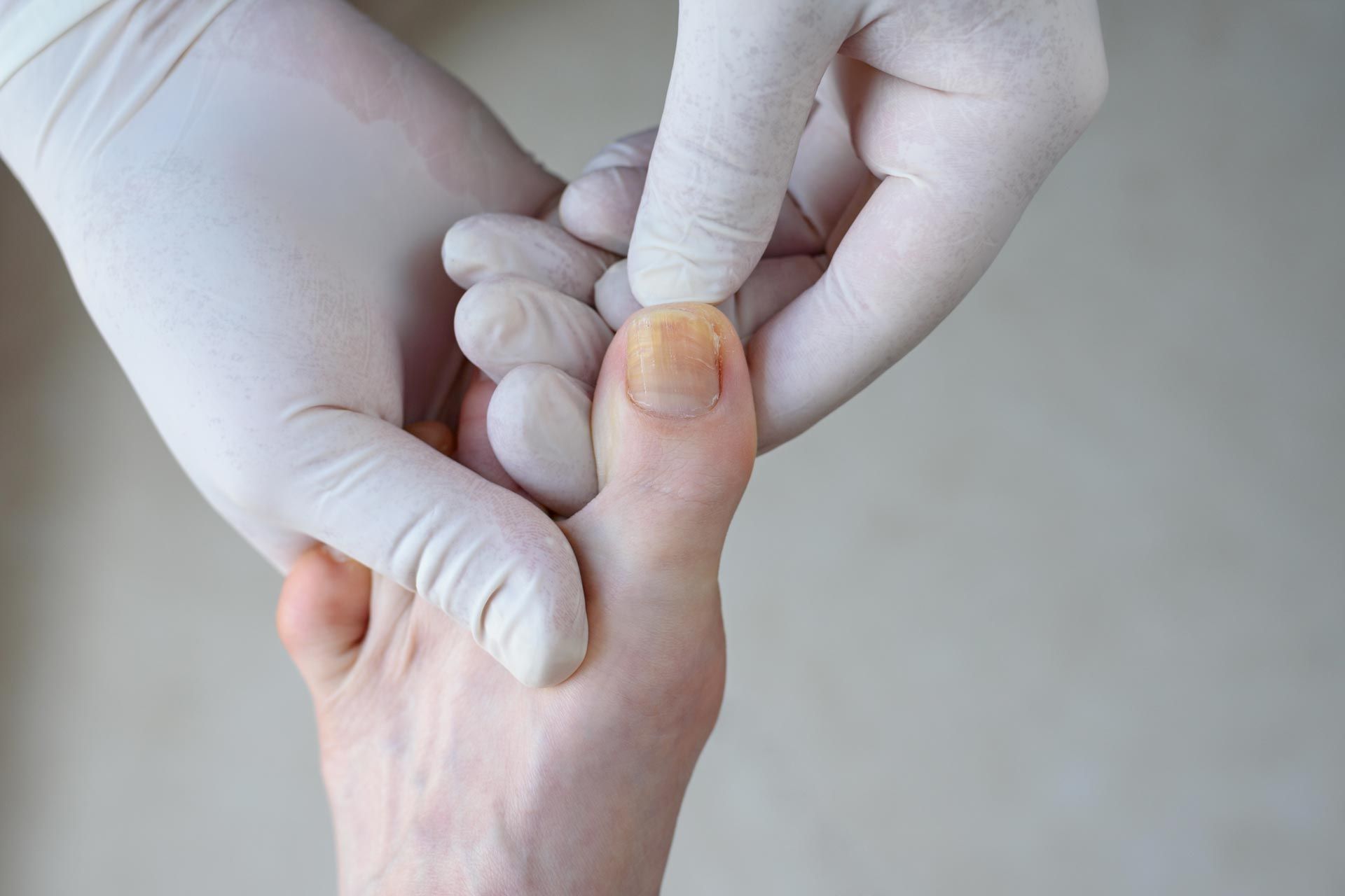 Gloved hands examining and pressing a big toe with a yellowed toenail