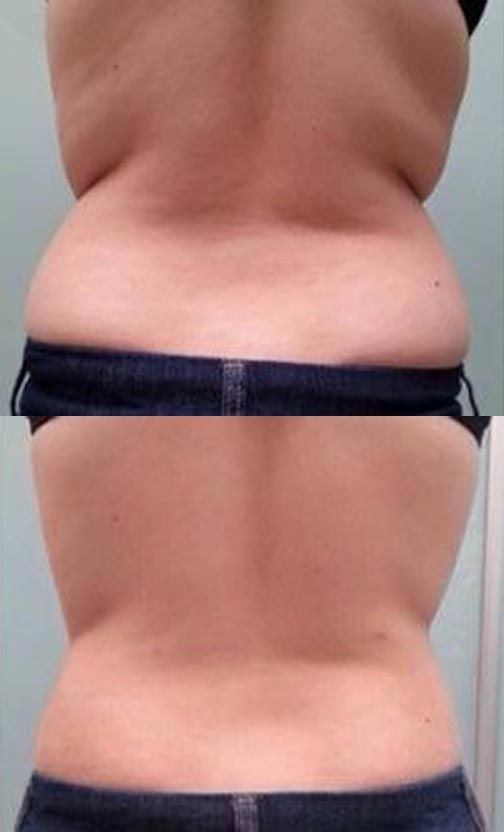 Close-up of a torso with visible skin folds and a black waistband across the middle