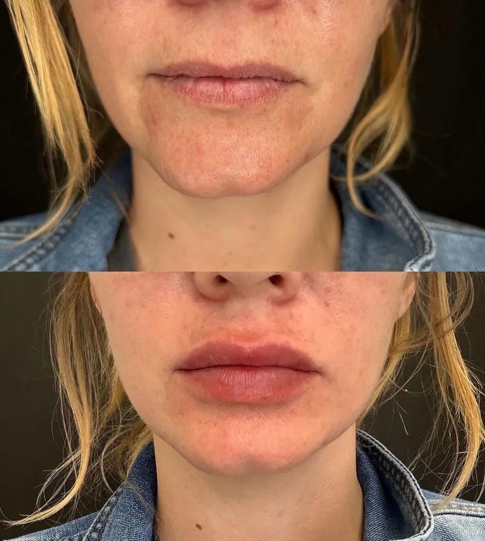 Close-up comparison of lips before and after treatment, showing fuller, more defined lips on bottom.