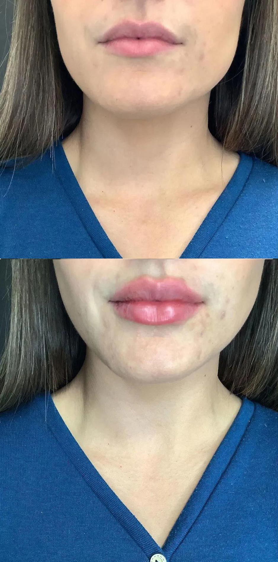 Close-up of lower face and neck in blue V-neck top, shown before and after lip enhancement surgery