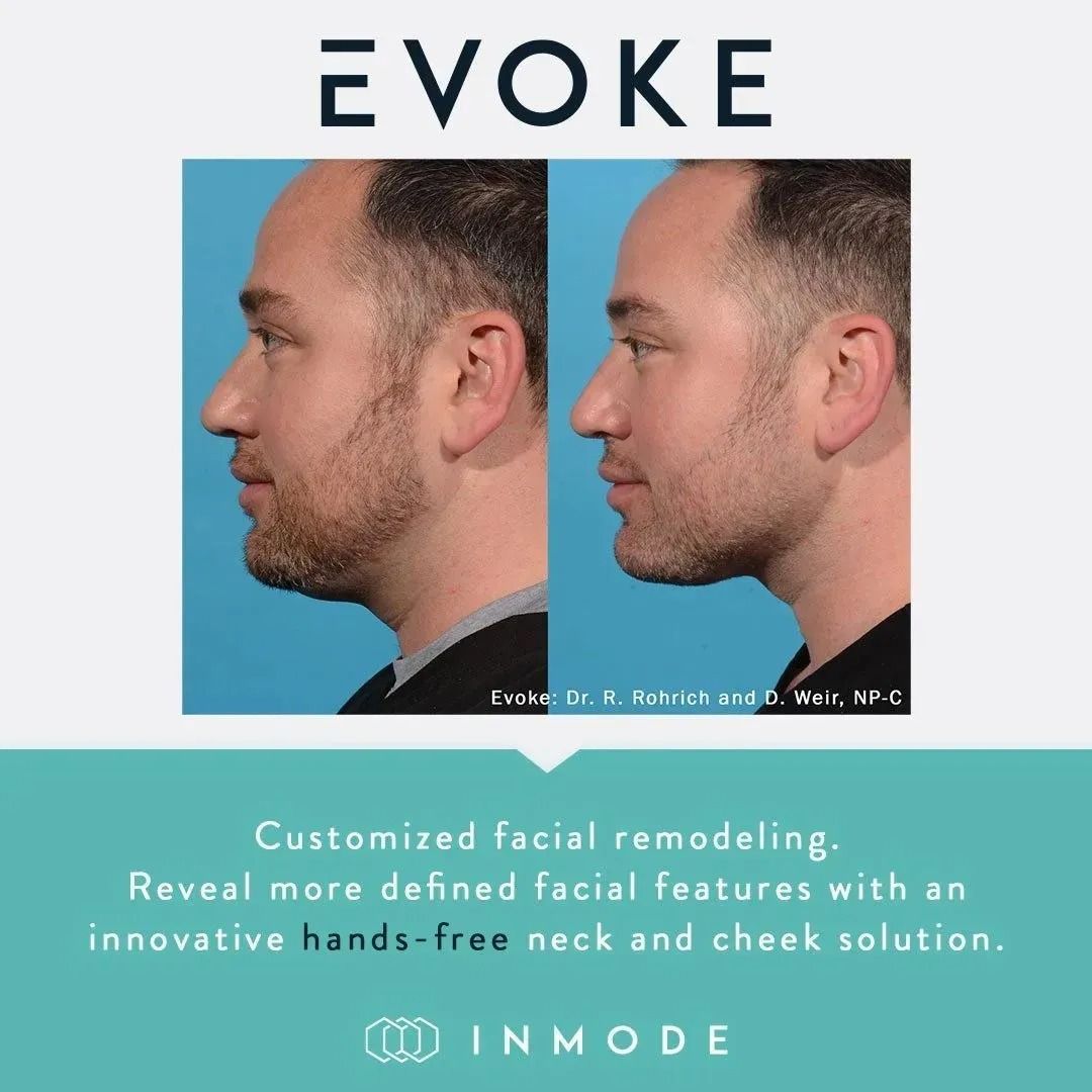 EVOKE ad showing side-by-side male profile before-and-after chin and jawline contouring results