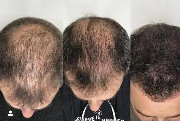 Top-down view of three people’s thinning hairlines showing bald spots on the crown.