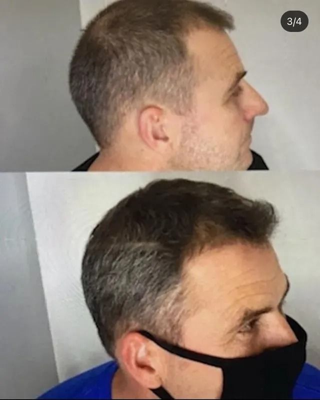 Side-by-side profile photos showing a man's hair thinning before and after a haircut.