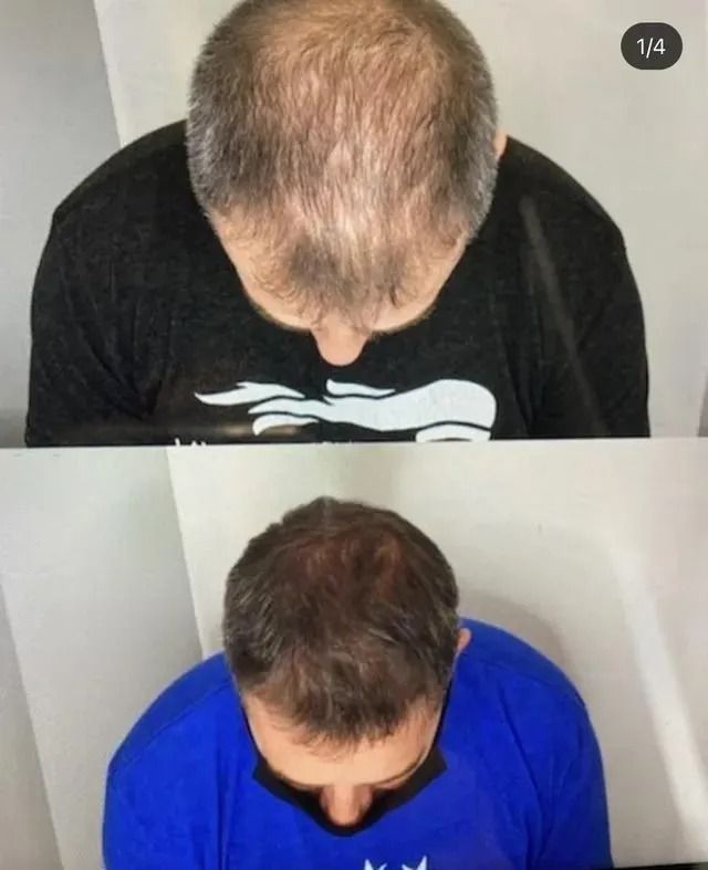 Before-and-after top-down views of a person with thinning hair, showing more hair growth in the lower image