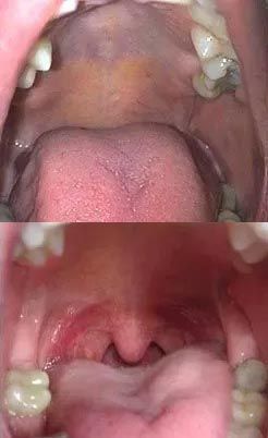 Two close-up mouth photos showing the palate and uvula from different angles.