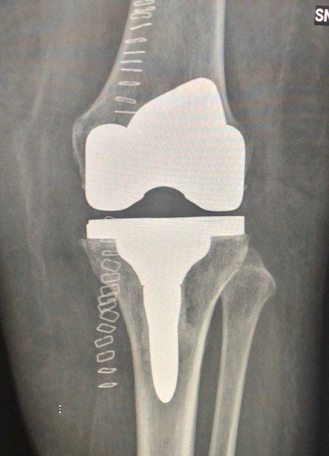 lesioni meniscali
