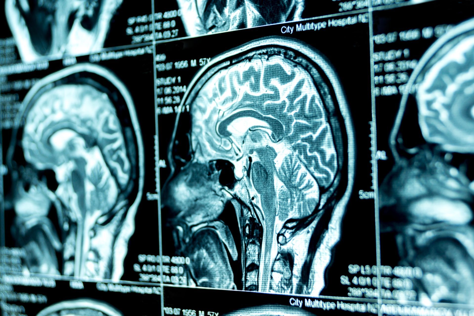 Three brain MRI scans displayed on a medical screen in blue tones