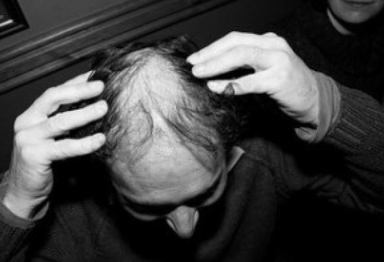 Mani che esaminano il cuoio capelluto diradato: costi del trapianto di capelli e attenzione alle offerte