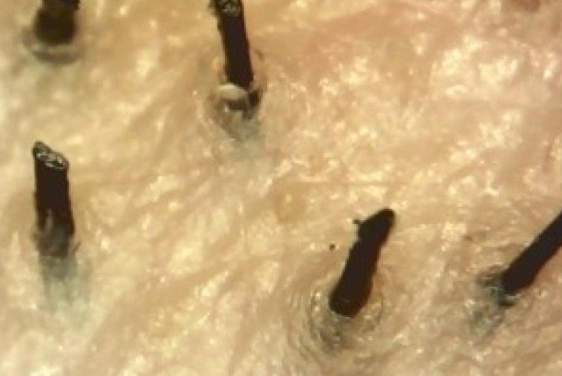 Primo piano di follicoli piliferi estratti con tecnica FUE per trapianto di capelli