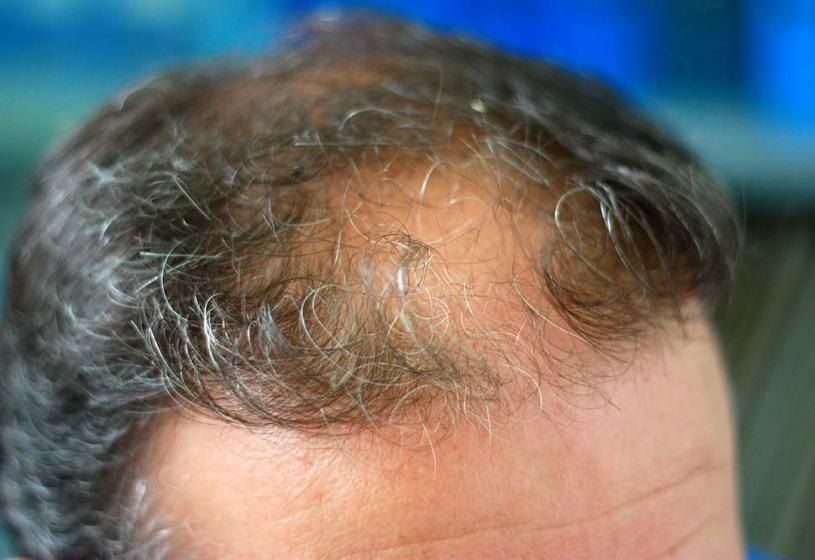 Cuoio capelluto con capelli grigi e una calvizie visibile frontalmente: cosa fare per la perdita di capelli in vecchiaia