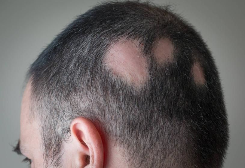 Primo piano di un cuoio capelluto con perdita di capelli a chiazze e diradamento dei capelli, che mostra diverse zone calve.