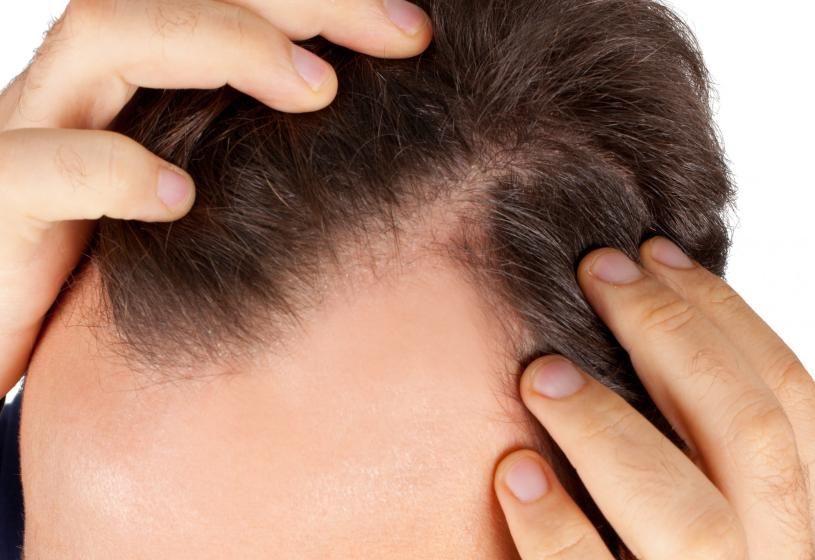Mani che separano i capelli per mostrare la stempiatura bilaterale e la perdita di densità nella zona frontale