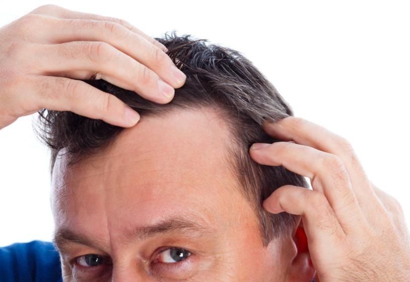 Uomo che si passa le mani tra i capelli diradati allo specchio: 7 consigli pratici per fermare la caduta dei capelli