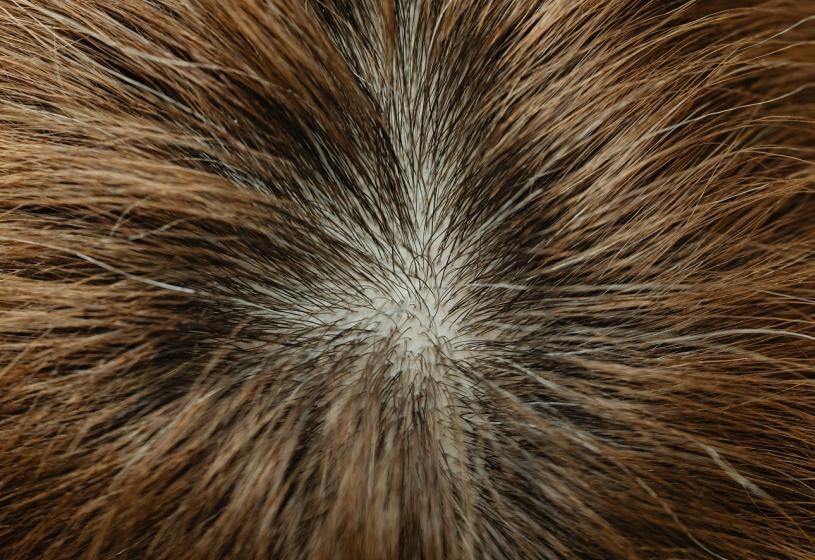 Cuoio capelluto visto dall'alto con diradamento: prodotti per riattivare i follicoli piliferi