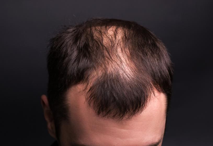 Vista dall'alto della sommità del capo con evidente diradamento dei capelli
