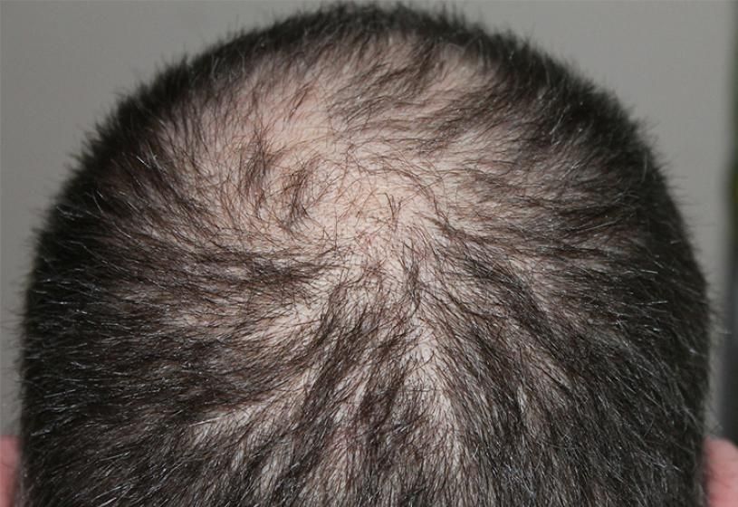 Vista dall'alto del cuoio capelluto con ampia chiazza di alopecia areata centrale tra i capelli:si può guarire senza farmaci?