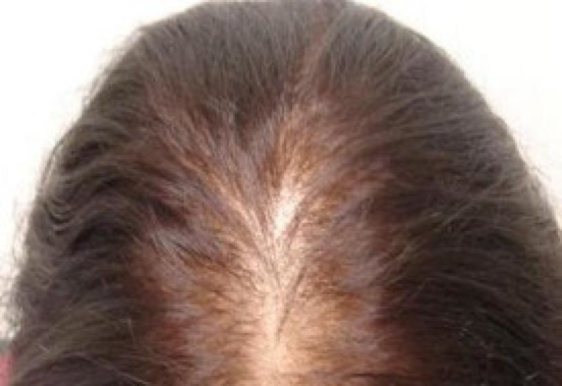 Vista dall'alto del cuoio capelluto femminile con diradamento diffuso: alopecia nelle donne,fenomeno da monitorare e trattare