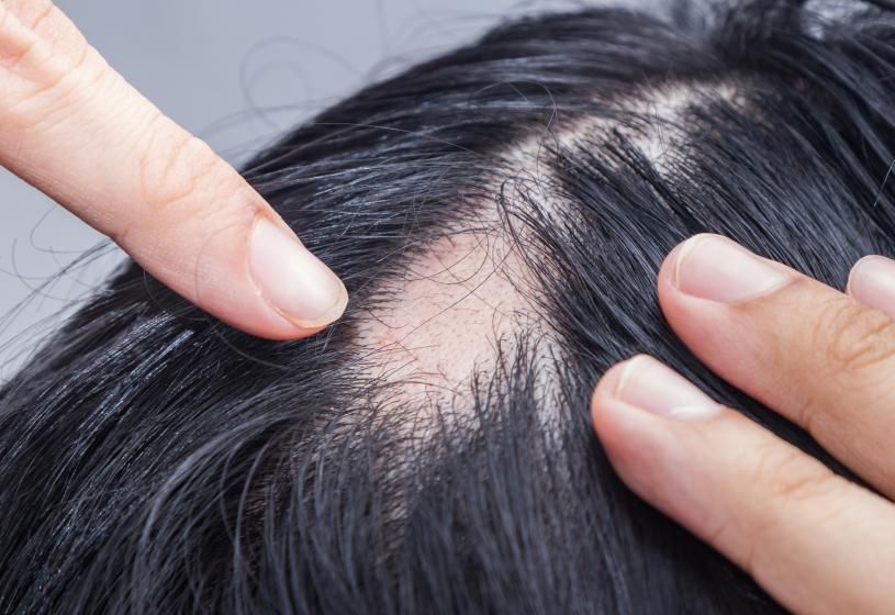 Dito che indica una chiazza di alopecia areata incognita tra i capelli folti: 5 risposte su come si cura questa alopecia