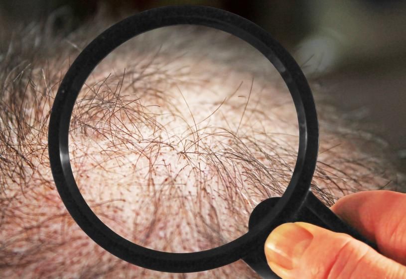 Lente d'ingrandimento sul cuoio capelluto diradato: analisi della tricopigmentazione vantaggi e limiti