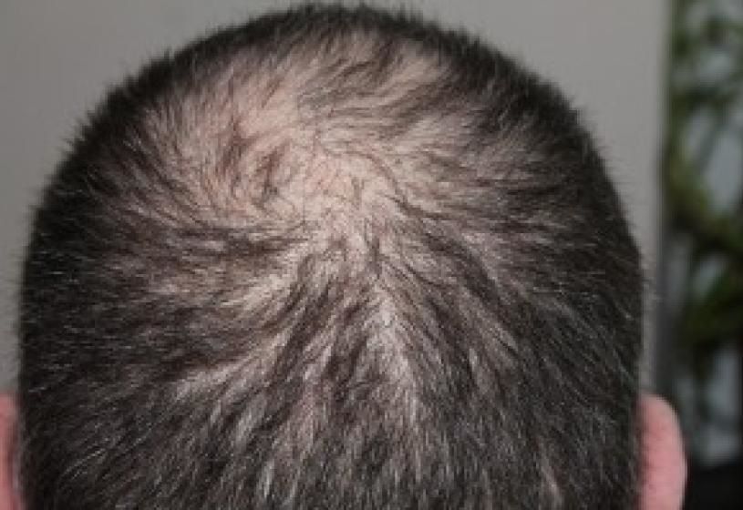 Cuoio capelluto di un uomo con diradamento diffuso e capelli radi: calvizie precoce, un fenomeno sempre più in aumento