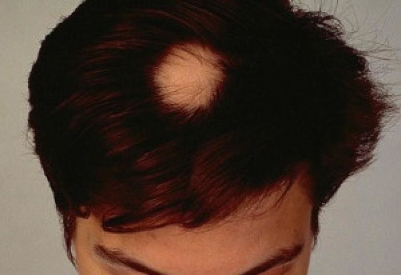 Chiazza di alopecia areata sul cuoio capelluto femminile: sintomi e terapie disponibili