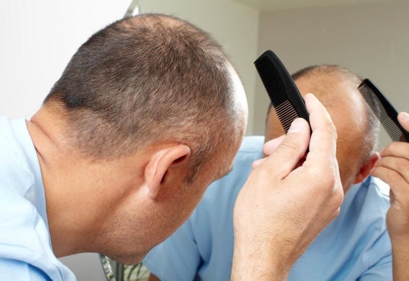 Un uomo esamina i capelli diradati allo specchio: consigli per la prevenzione delle calvizie ereditaria