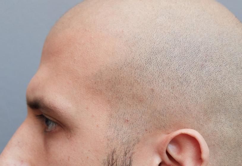 Testa calva vista di profilo: la stanchezza cronica come possibile causa della perdita di capelli