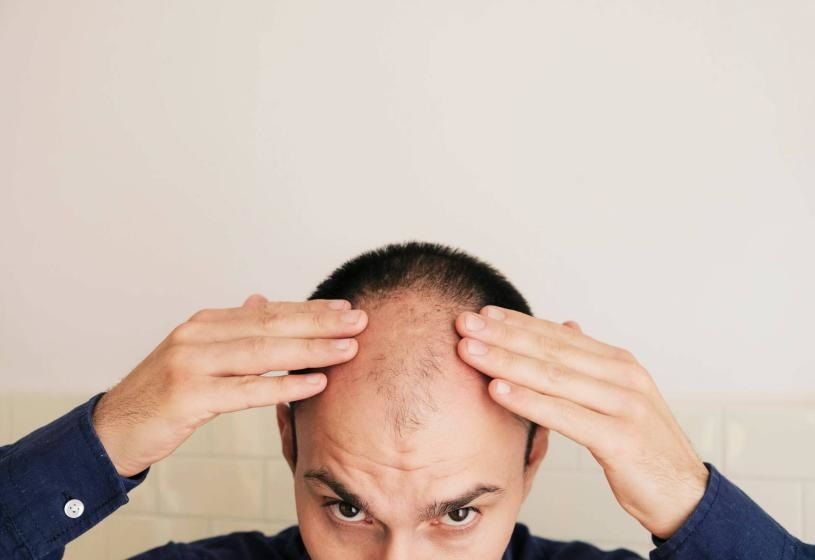 Uomo che si tocca l'attaccatura frontale con diradamento e stempiatura: 5 rimedi naturali per arginare l'alopecia seborroica