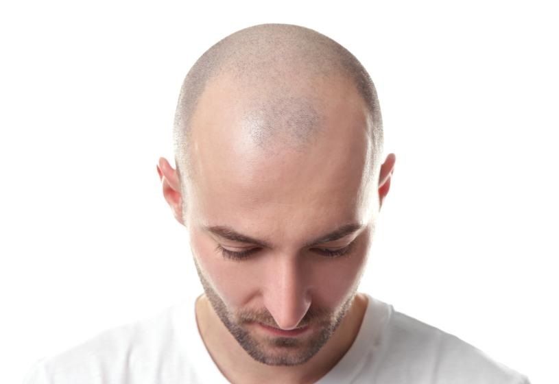 Uomo con testa rasata: criteri e profili ideali per candidarsi al trapianto di capelli