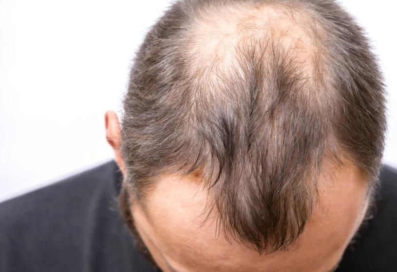 Uomo con capelli diradati al centro del capo: alopecia da stress, come si guarisce naturalmente