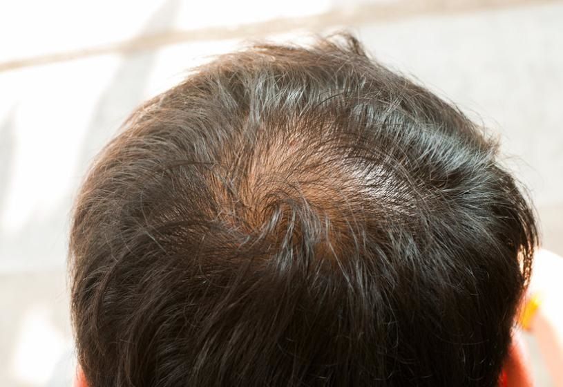 Parte superiore della testa di una persona con capelli diradati e una zona calva visibile.