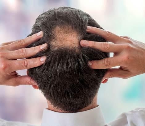 Vista dall'alto del cuoio capelluto maschile con chiazza di alopecia areata sulla sommità: sintomi, diagnosi e terapie