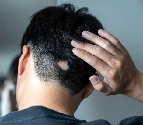 Uomo che mostra una chiazza di alopecia sulla nuca: alopecia cicatriziale, perdita permanente dei follicoli piliferi