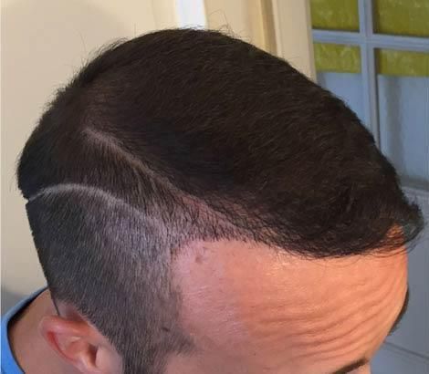 Risultato finale dell'autotrapianto FUE: ricrescita naturale e densa dei capelli con attaccatura frontale ripristinata