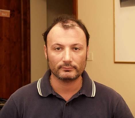 Prima del trattamento di infoltimento capelli: cuoio capelluto con diradamento visibile