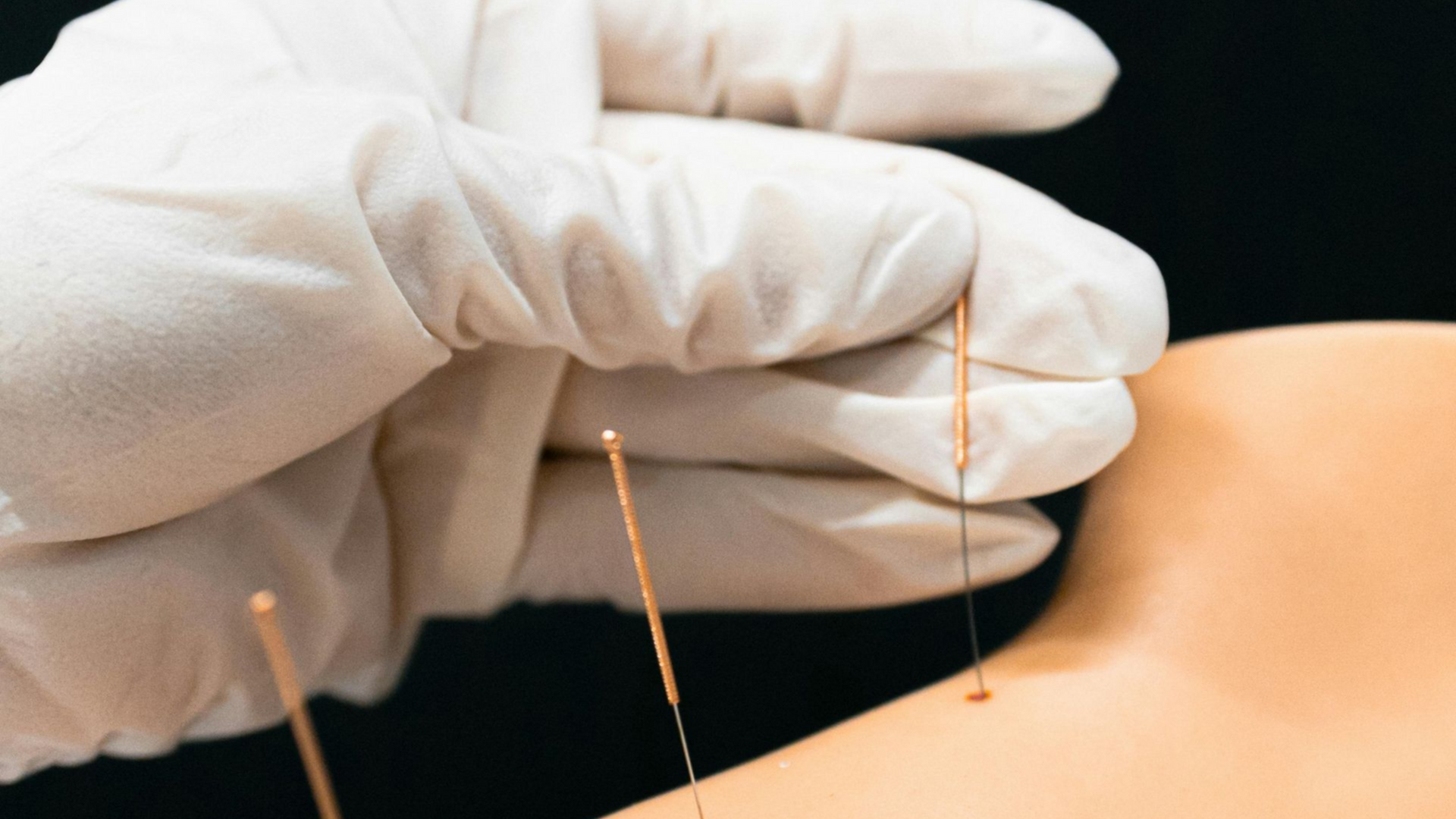 Gloved hand inserting acupuncture needles into a person's shoulder against a black background near  Raeford, NC.