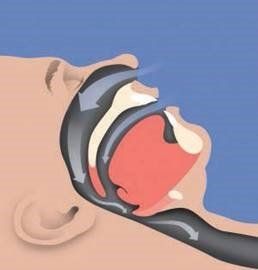 Normal Airway— Petersham, NSW — Petersham Dental Practice