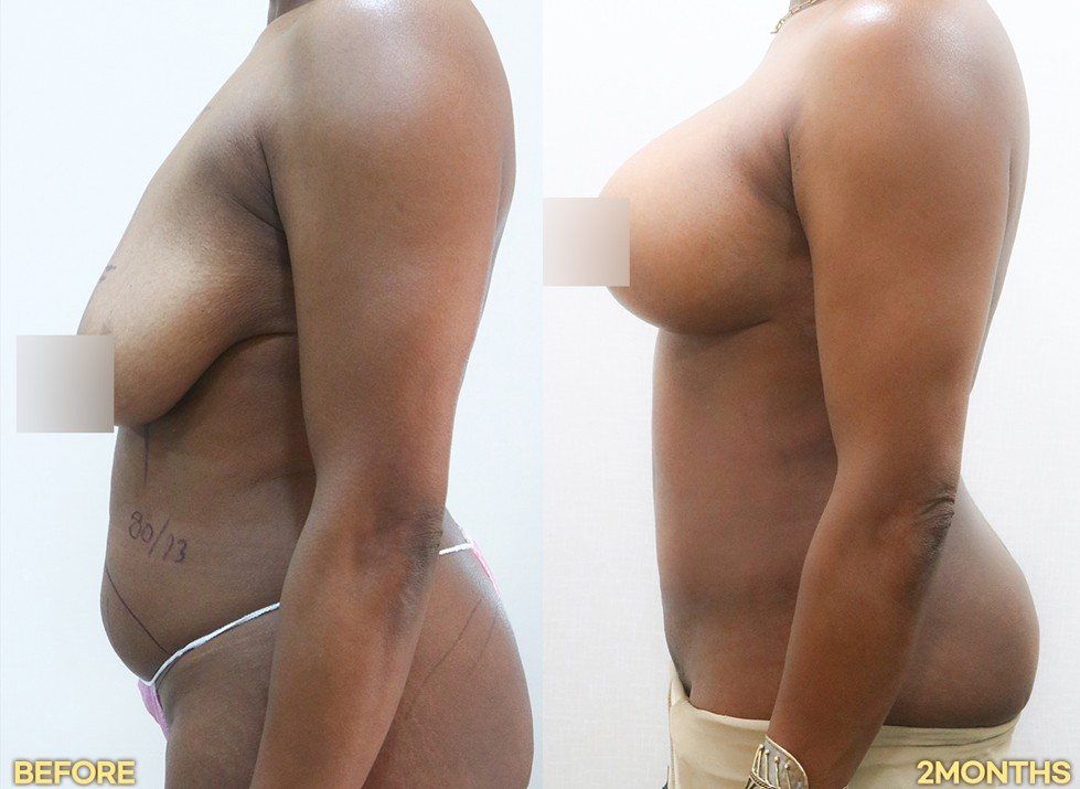 Breast surgery, side view: before and 2 months at Grand Plastic Surgery, Seoul