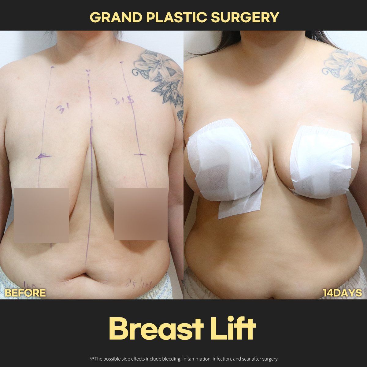 Breast lift: before and 14 days at Grand Plastic Surgery, Seoul