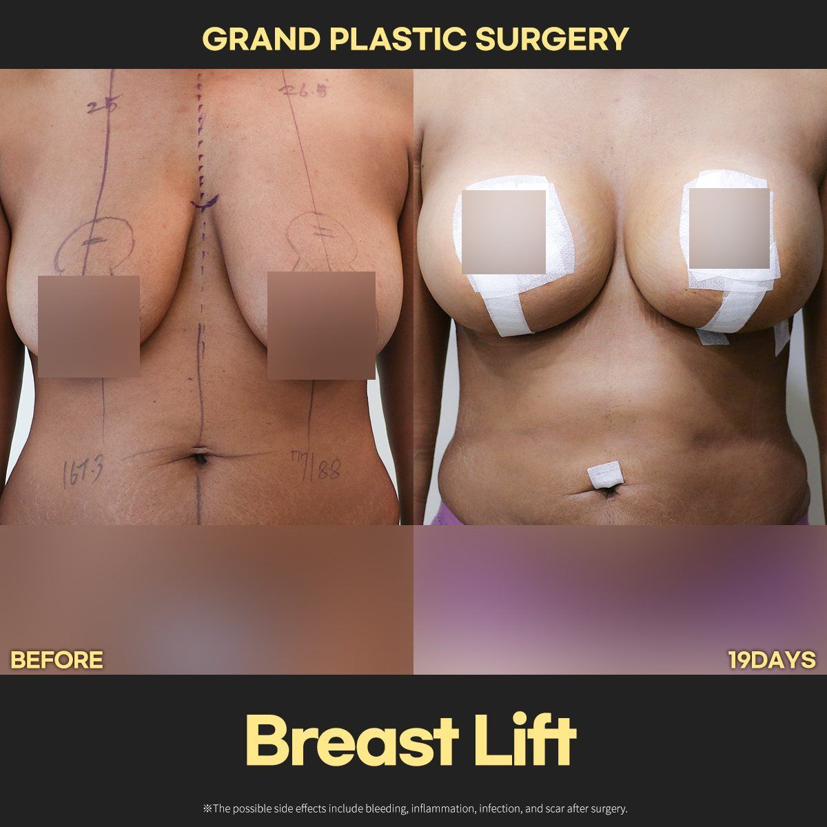 Breast lift: before and 19 days at Grand Plastic Surgery, Seoul