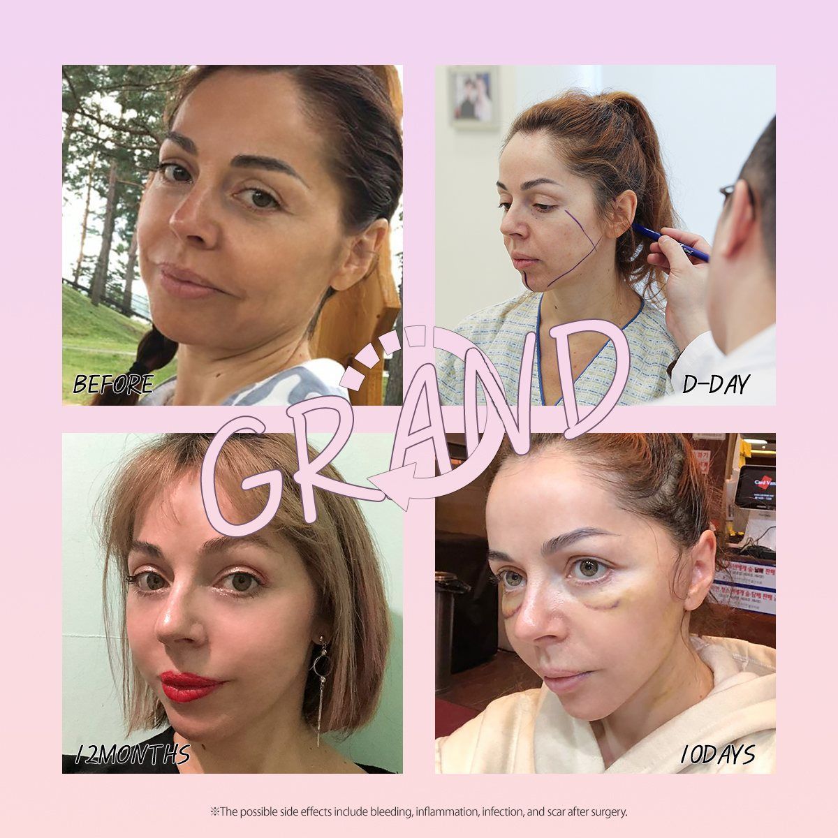 Face and neck lift: before, surgery day, 10 days and 12 months at Grand Plastic Surgery, Seoul