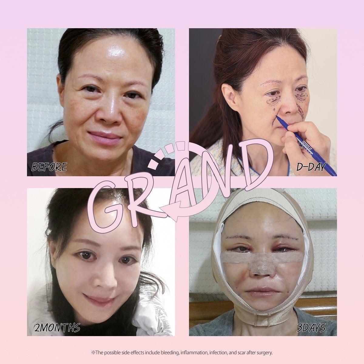 Face and neck lift: before, surgery day, 3 days and 2 months at Grand Plastic Surgery, Seoul