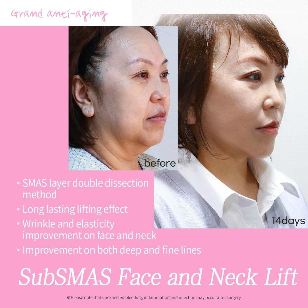 SubSMAS face and neck lift: before and 14 days at Grand Plastic Surgery, Seoul