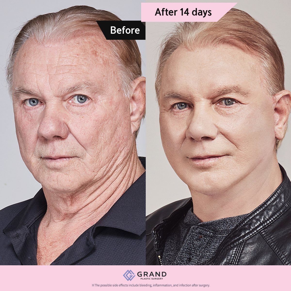 Male face and neck lift: before and 14 days at Grand Plastic Surgery, Seoul
