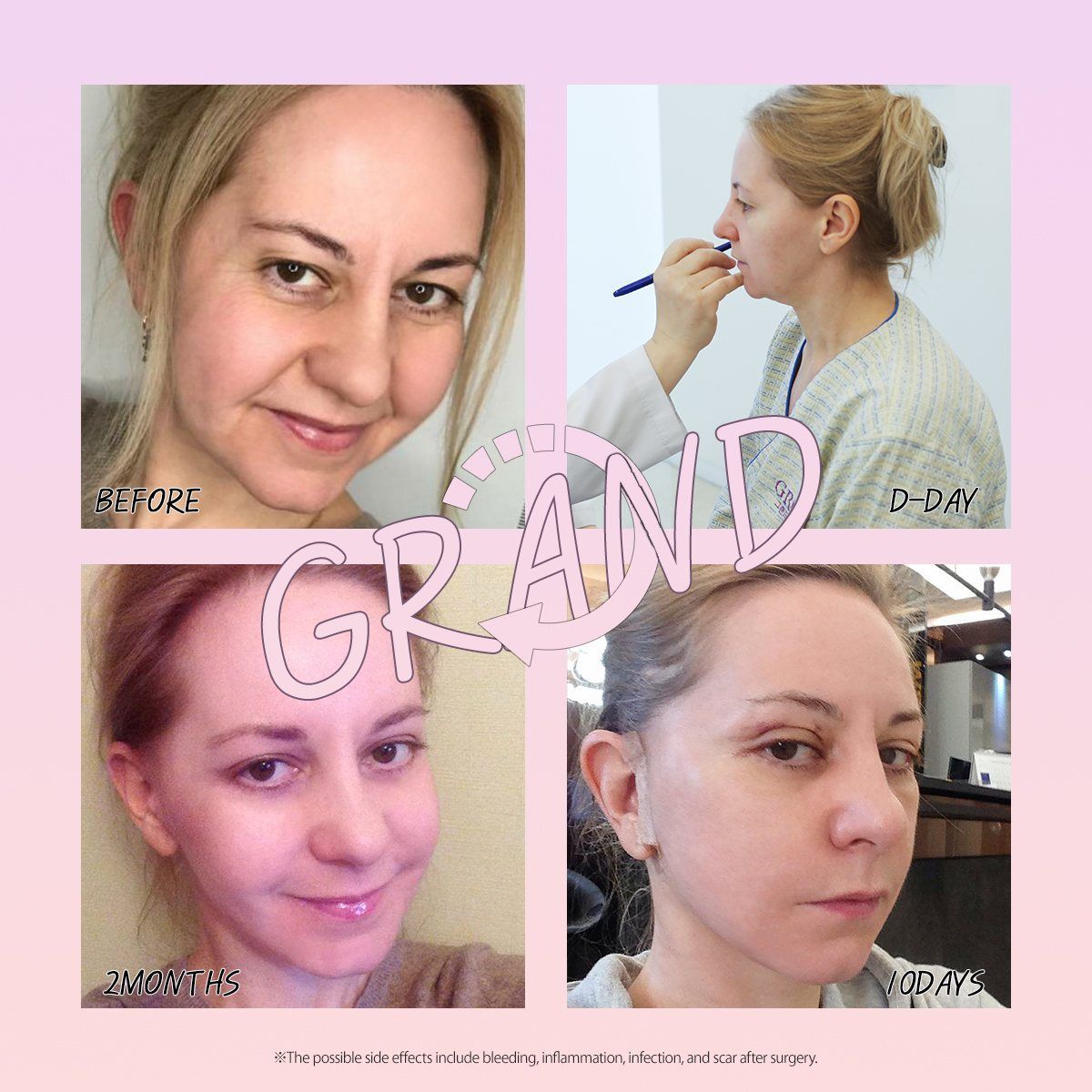 Face and neck lift: before, surgery day, 10 days and 2 months at Grand Plastic Surgery, Seoul