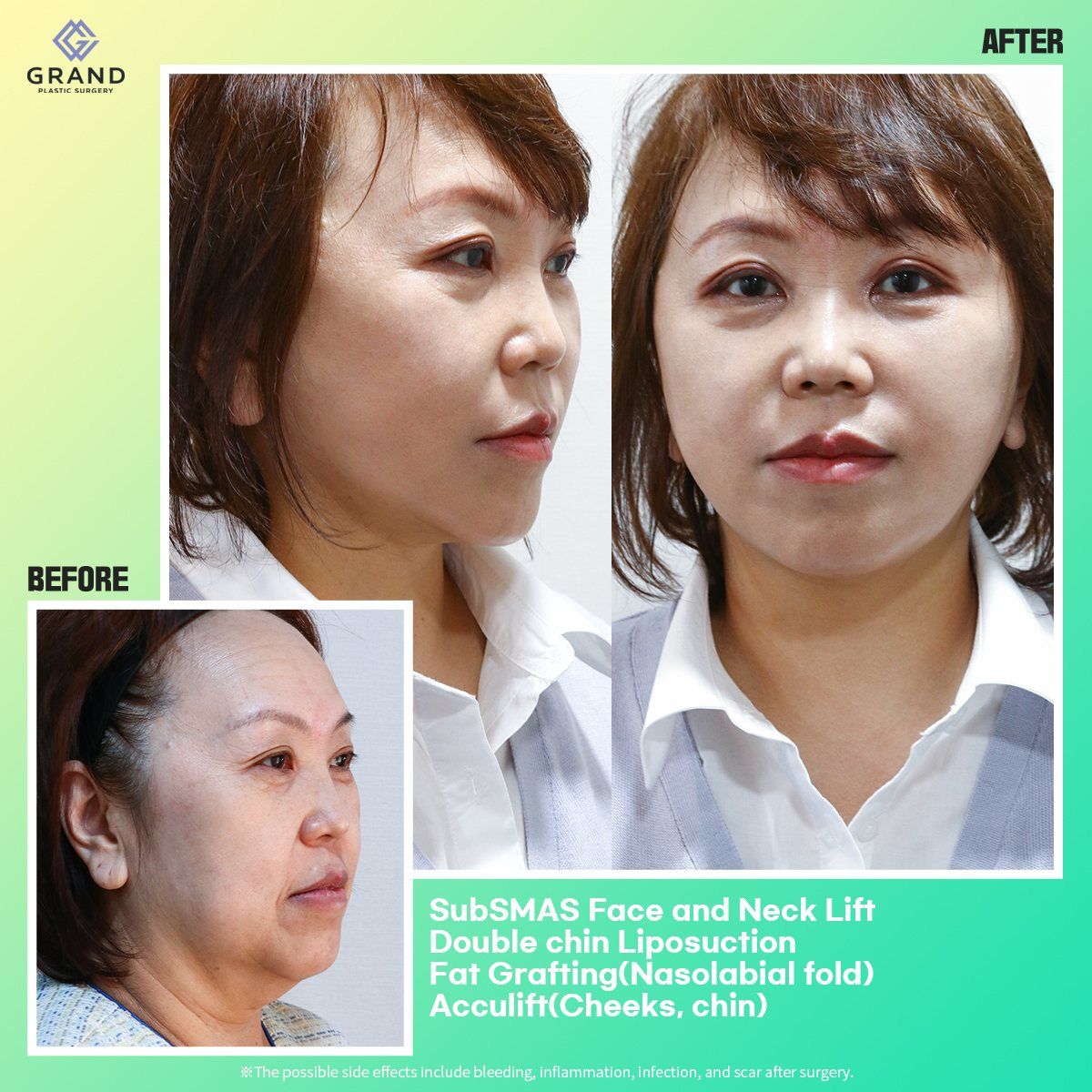 SubSMAS face and neck lift with double chin liposuction, fat grafting and Acculift at Grand Plastic Surgery, Seoul