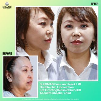 Deep plane facelift before and after